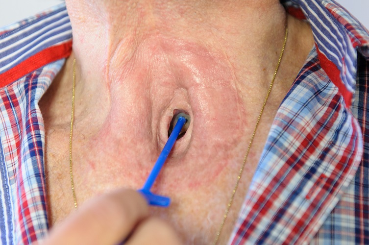 Provox Brush gebruiken | Atos Medical