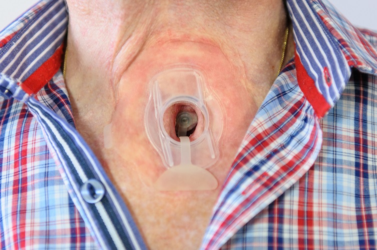 Provox Plug ingebracht | Atos Medical